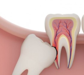How To Control Wisdom Teeth Problem: Reducing The Wisdom Teeth Swelling