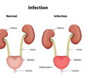 8 Vital Tips To Prevent Catheter-Related Urinary Tract Infection (UTI)