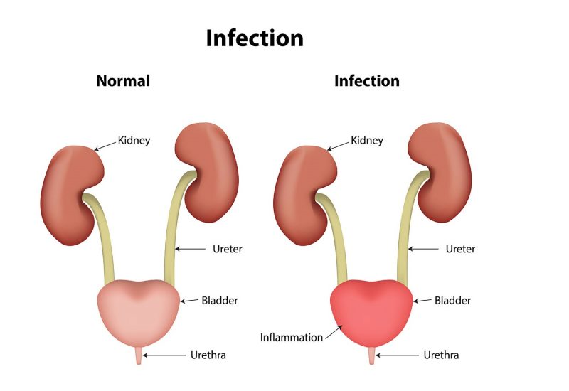 8 Vital Tips To Prevent Catheter-Related Urinary Tract Infection (UTI)